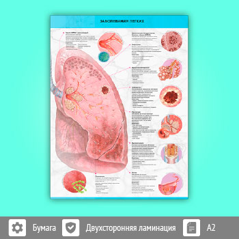 Плакат «Заболевания легких» (М-30, ламинированная бумага, A2, 1 лист)